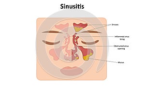 Sinusitis vector illustration
