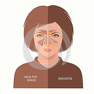Sinusitis disease, photo