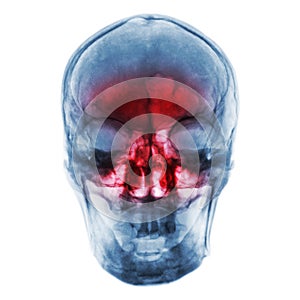 Sinusitis . Film x-ray of human skull with inflamed at sinus