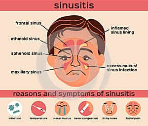 Sinusitis Flat Infographics photo