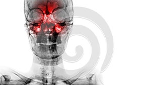 Sinusitis at frontal , ethmoid , maxillary sinus . Film x-ray of skull and blank area at right side