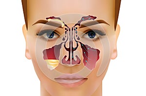 Sinusitis. Healthy and inflammation nasal sinus vector illustration photo