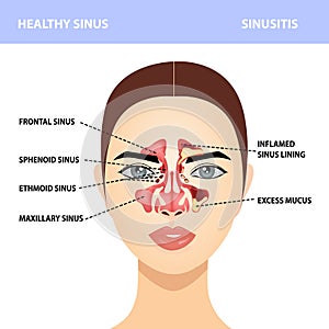 Sinusitis. Healthy and sinus infections, signs, realistic illustration for medical posters and educational materials