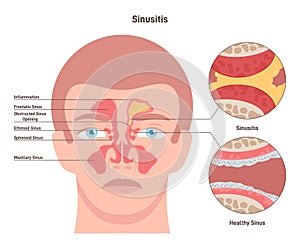 Sinusitis. Inflamed sinus with excess mucus and obstructed airways