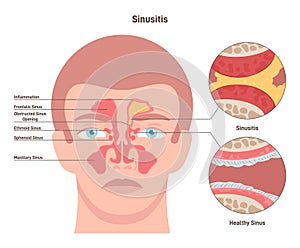 Sinusitis. Inflamed sinus with excess mucus and obstructed airways photo