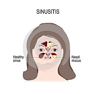 Sinusitis. sinus infection. photo
