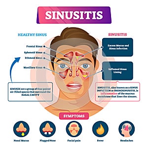 Sinusitis vector illustration. Labeled rhinosinusitis inflammation scheme.