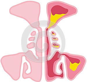 Sinusitis, vector illustration, labeled photo