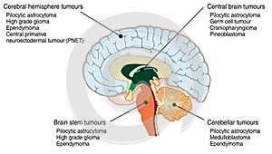 Sites of various brain tumours