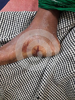 After six hour the Neurotoxic snake bite the leg look