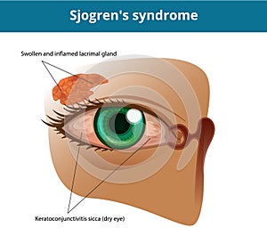 Sjogren`s syndrome or dry eye syndrome. Keratoconjuctivitis sicca photo