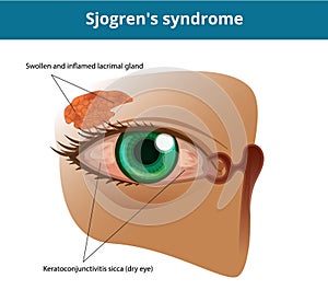 Sjogren`s syndrome or dry eye syndrome. Keratoconjuctivitis sicca