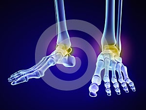 Skeletal foot - injuryd talus bone. Medically accurate 3D illustration photo