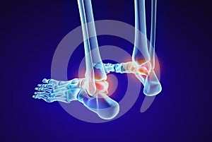 Skeletal foot - injuryd talus bone. Xray view. Medically accurate illustration photo