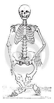 Skeleton deformed by rickets, vintage engraving