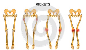 The skeleton of the lower limbs in rickets