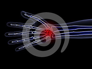 Skeleton X-Ray - Wrist Pain