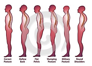 Skeleton_Spine Posture