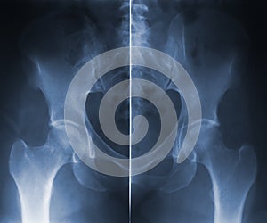Skiagram hip backbone photo