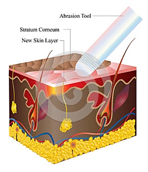 Skin abrasion photo