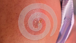 Skin abscess requite incisiin and drainage