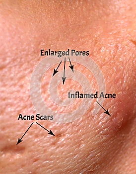 Skin with acne, acne scars, enlarged pores.