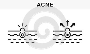 Skin Acne, Blackhead, Comedo Line and Silhouette Black Icon Set. Pimple and Inflammation Sebum Pictogram. Deep Dirty photo