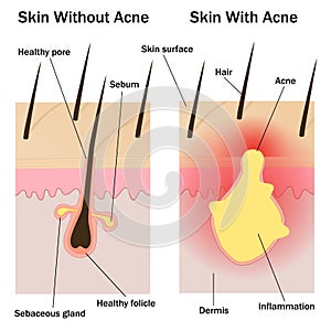 Skin with and without acne