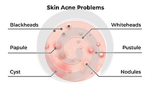 Skin acne types diagram. Vector skin problems disease, pimples blackheads and comedones, cosmetology skincare treatment