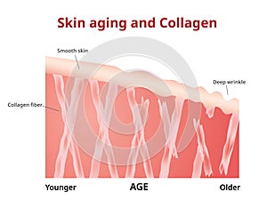 Kože starnutie kolagén v mladý a starý kože 