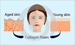 Skin aging diagrams. young skin is firm tight, its collagen Vector illustration with a face and two types of skin - aged