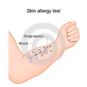 Skin allergy test. Human arm with allergen