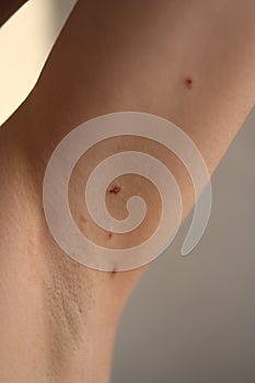The skin on the armpits after removal of papillomas by laser