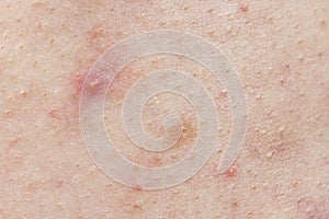 Skin background texture with pimples and blackheads. problematic skin close up. acne diseases
