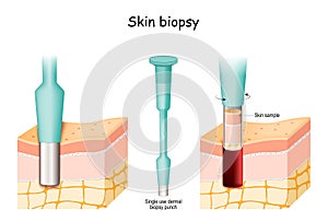 Skin Biopsy. Punch biopsy take skin sample photo