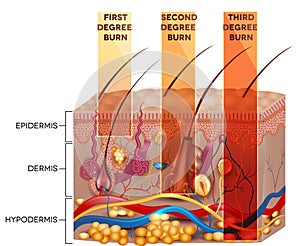 Skin burn classification