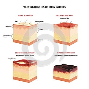 Skin burn classification.