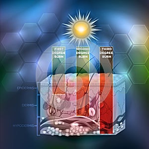 Skin burn classification