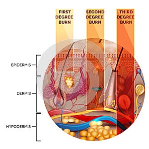 Skin burn classification in round shape photo