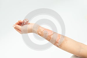 Skin burn on a female hand on a white background