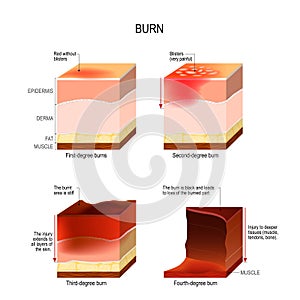 Skin burn. four degrees of burns.