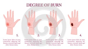 Skin burn injury stages infographic. Red skin and blisters, thermal