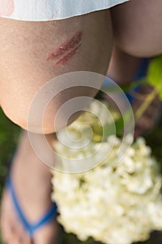 Skin burn made by plant on woman’s leg in nature background, red injured skin area with blisters on person’s body