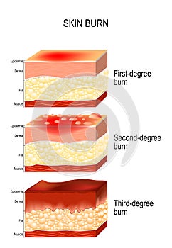 Skin burn. Three degrees of burns.