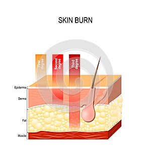 Skin burn. Three degrees of burns. photo