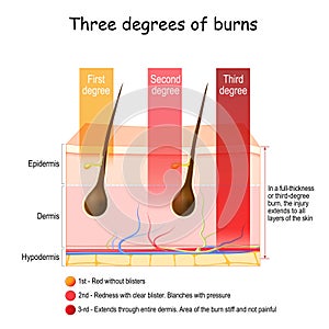 Skin burn. Three degrees of burns. type of injury to skin