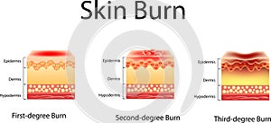 Skin burn. Three degrees of burns. type of injury to skin, Vector illustration