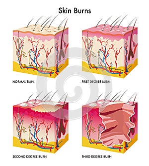 Skin burns photo