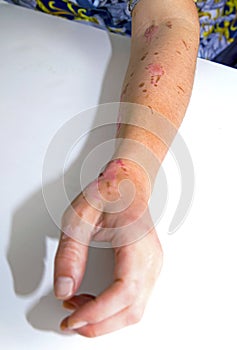 Skin burns on human arm