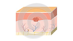 Skin cancer basal-cell malignant tumor